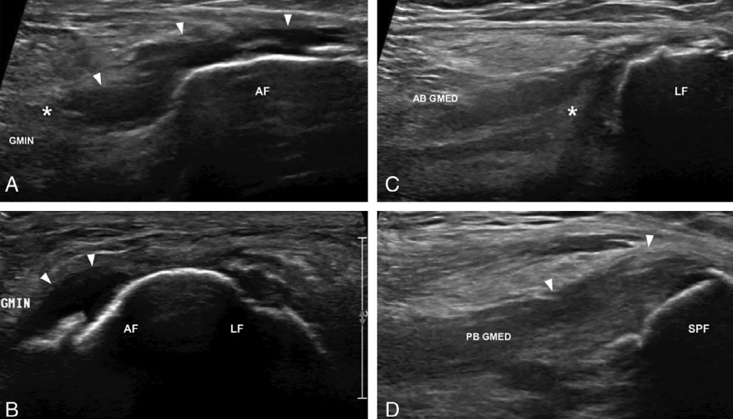 Gluteo menor 8 ecografia tempo formacion.jpg